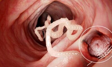 How to realize the presence of parasites in the human intestines
