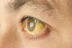 The whites of the eyes are yellow