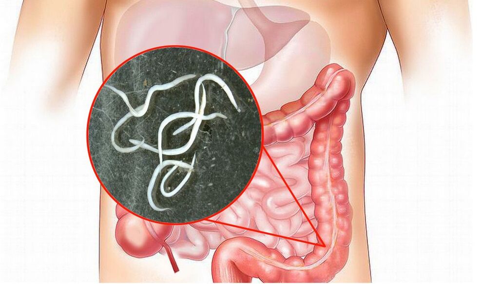 intestinal worm disease, treatment Normadex